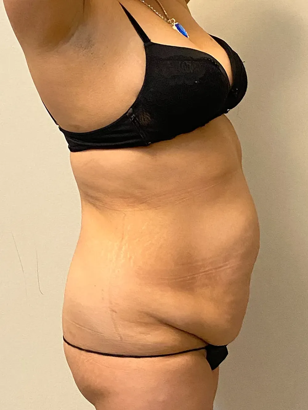 Tummy Tuck case #4934