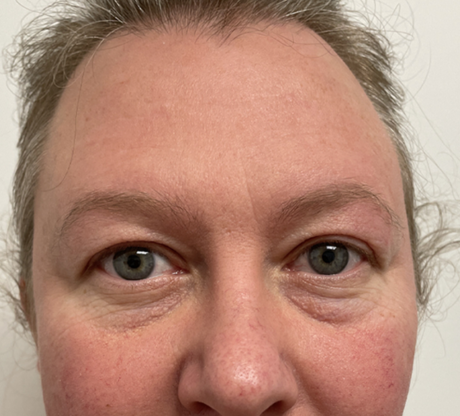 Blepharoplasty case #4592