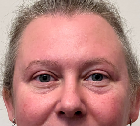 Blepharoplasty case #4592