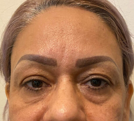 Blepharoplasty case #5256