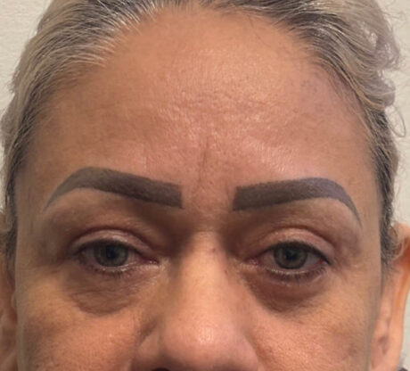 Blepharoplasty case #5256
