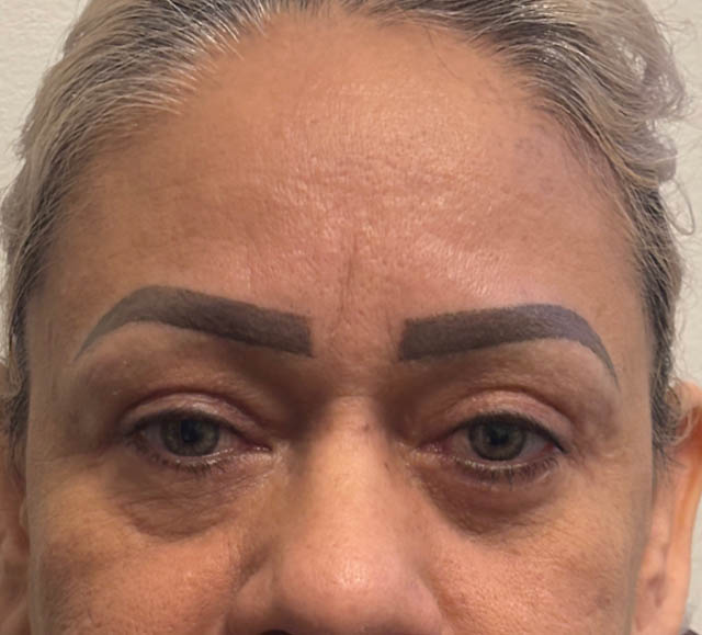 Blepharoplasty case #5256