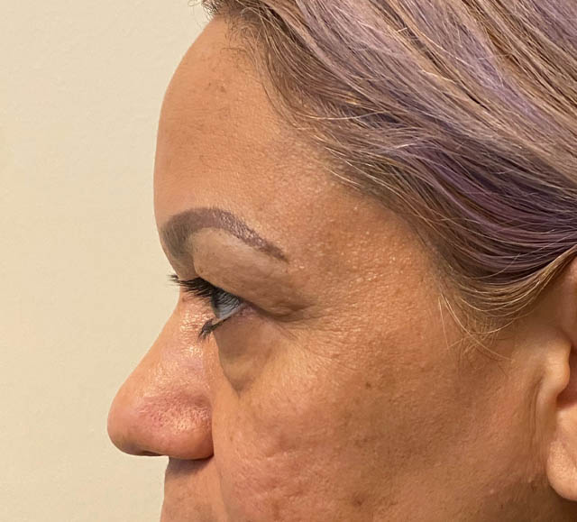 Blepharoplasty case #5256
