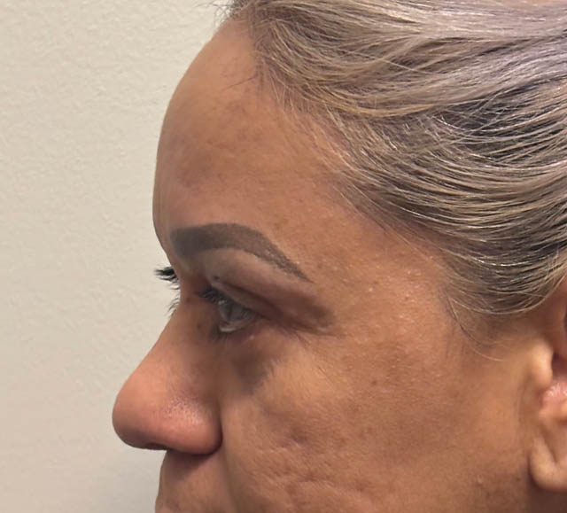 Blepharoplasty case #5256