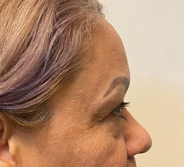 Blepharoplasty case #5256