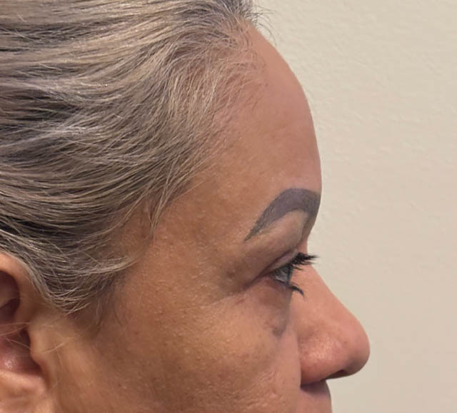 Blepharoplasty case #5256