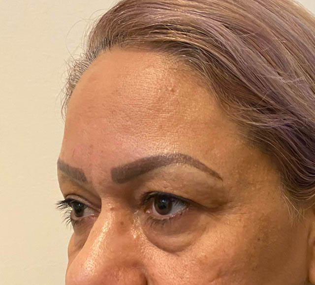 Blepharoplasty case #5256