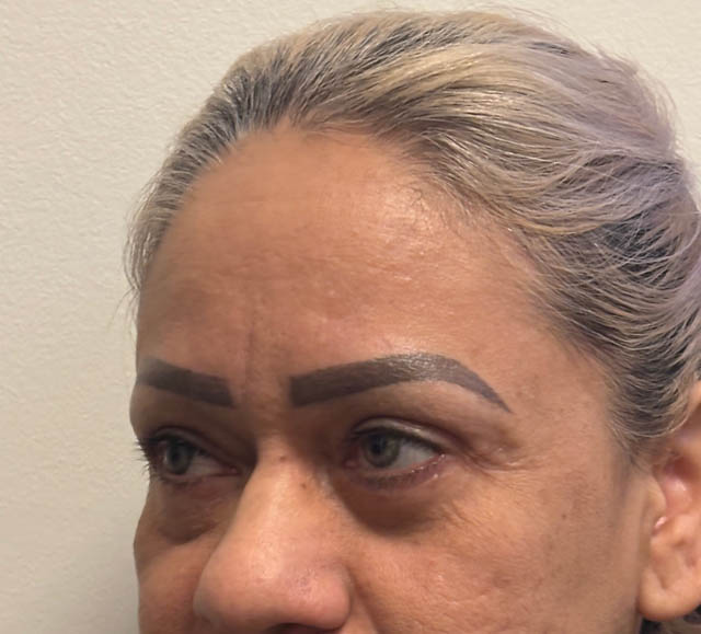 Blepharoplasty case #5256