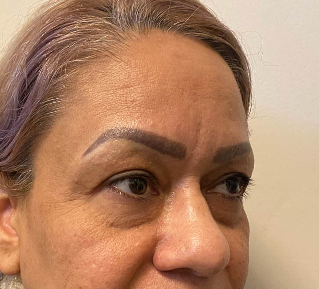 Blepharoplasty case #5256