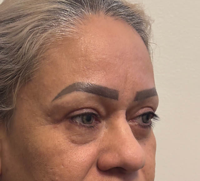 Blepharoplasty case #5256
