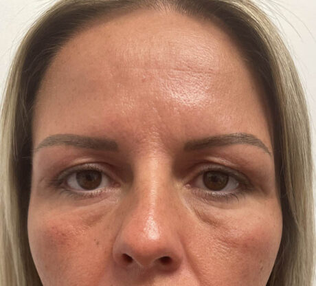 Blepharoplasty case #5274