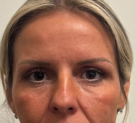 Blepharoplasty case #5274