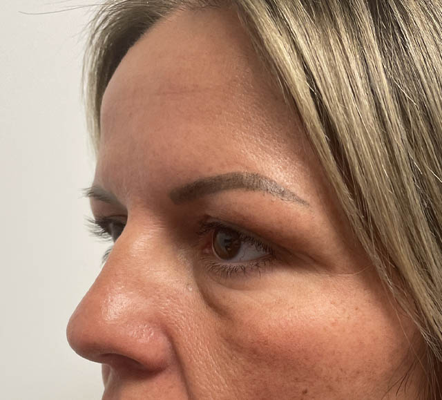 Blepharoplasty case #5274