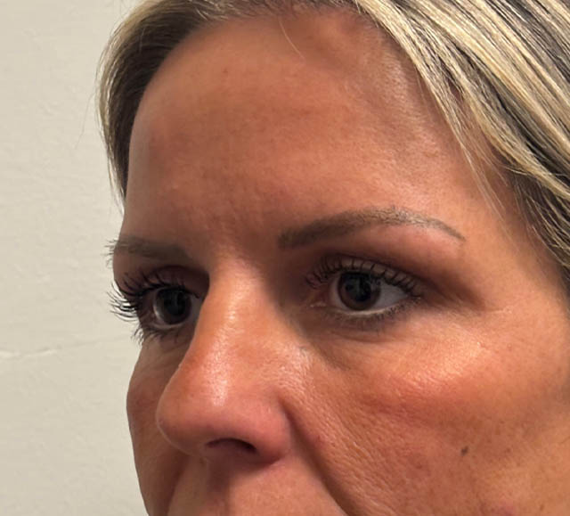 Blepharoplasty case #5274