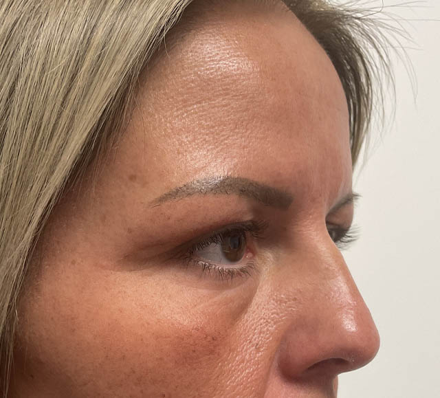 Blepharoplasty case #5274