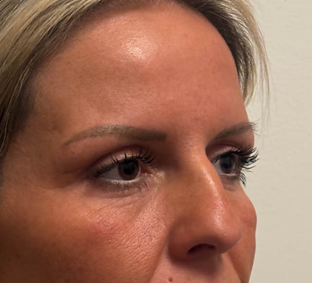 Blepharoplasty case #5274