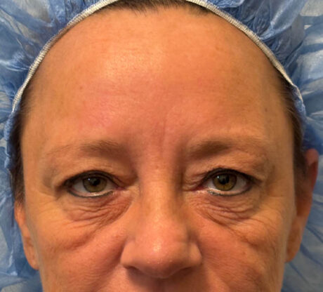 Blepharoplasty case #5281
