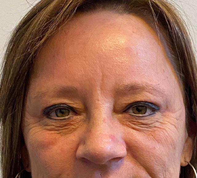 Blepharoplasty case #5281
