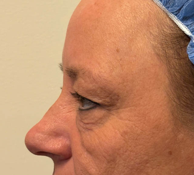 Blepharoplasty case #5281