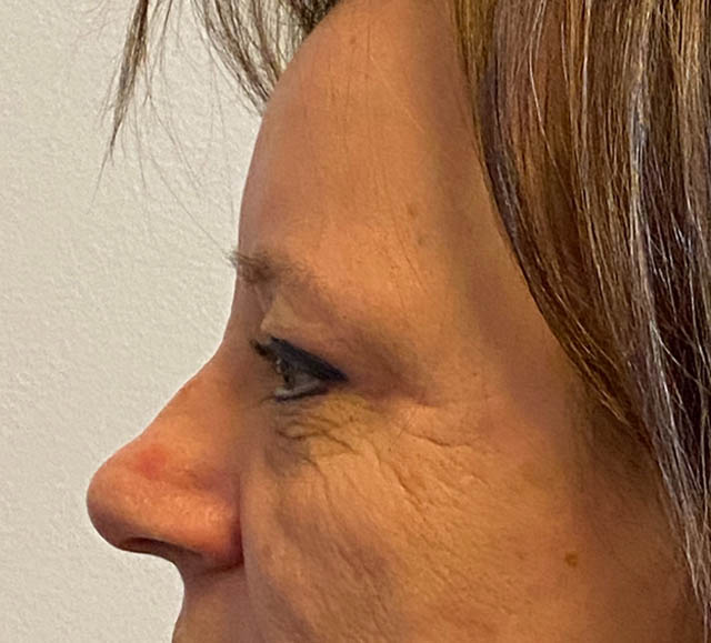 Blepharoplasty case #5281