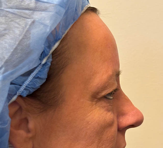 Blepharoplasty case #5281