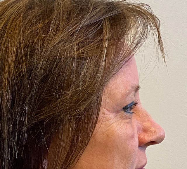 Blepharoplasty case #5281
