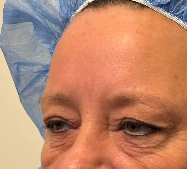 Blepharoplasty case #5281