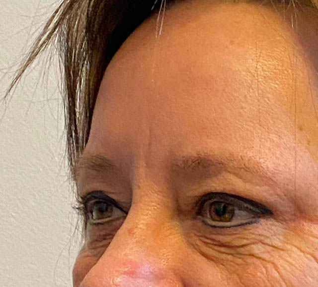Blepharoplasty case #5281