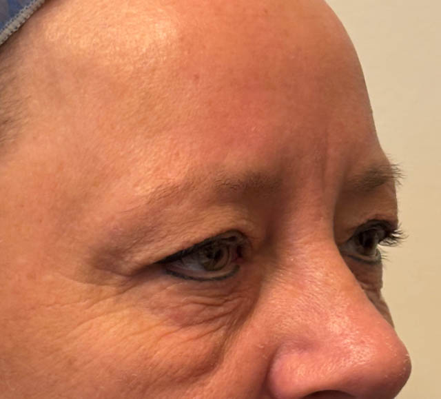 Blepharoplasty case #5281