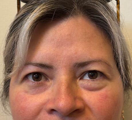 Blepharoplasty case #5302