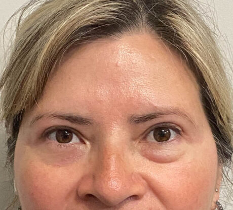 Blepharoplasty case #5302