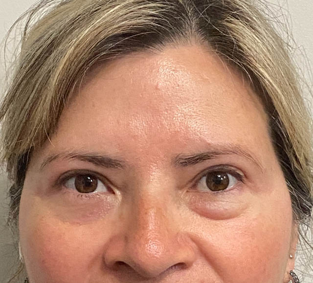 Blepharoplasty case #5302