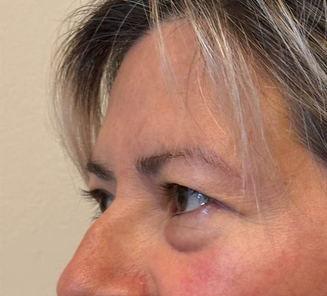 Blepharoplasty case #5302