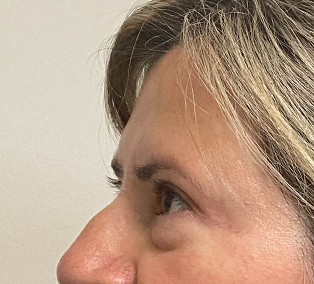 Blepharoplasty case #5302