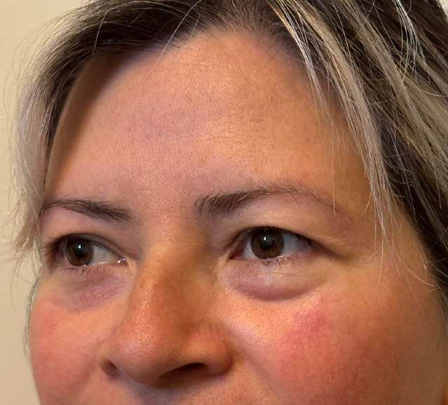 Blepharoplasty case #5302