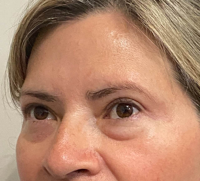 Blepharoplasty case #5302
