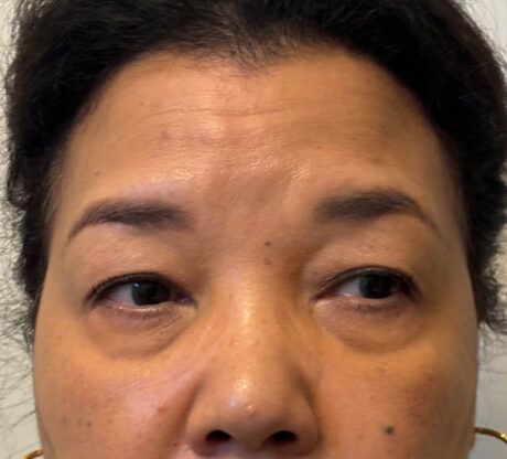 Blepharoplasty case #5311
