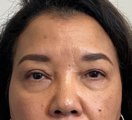 Blepharoplasty case #5311