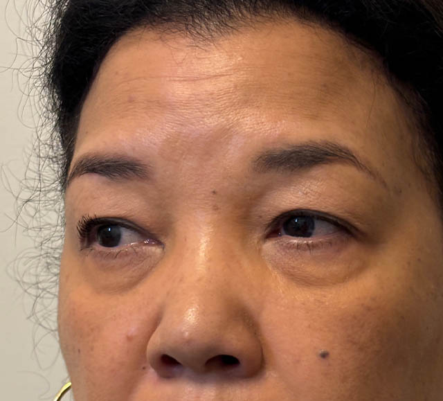 Blepharoplasty case #5311
