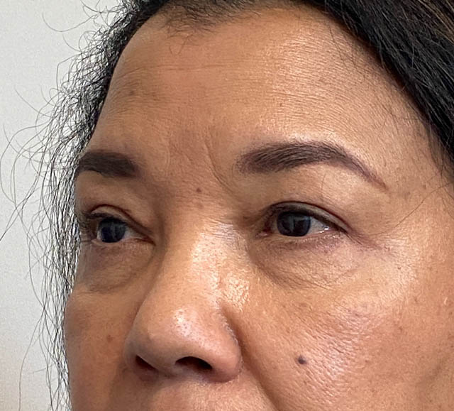 Blepharoplasty case #5311