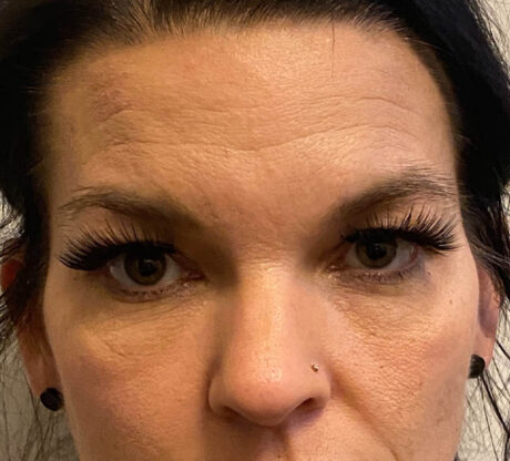 Blepharoplasty case #5316