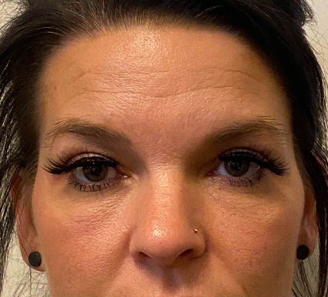 Blepharoplasty case #5316