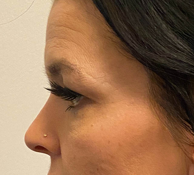 Blepharoplasty case #5316