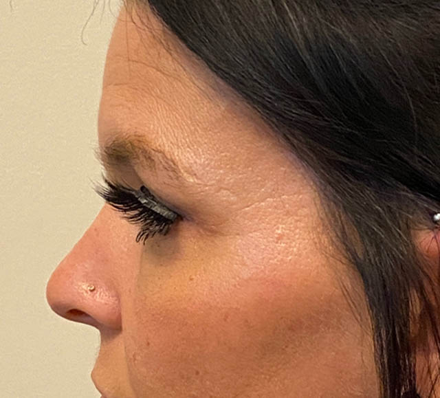 Blepharoplasty case #5316