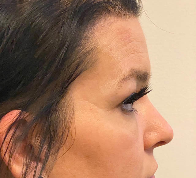 Blepharoplasty case #5316