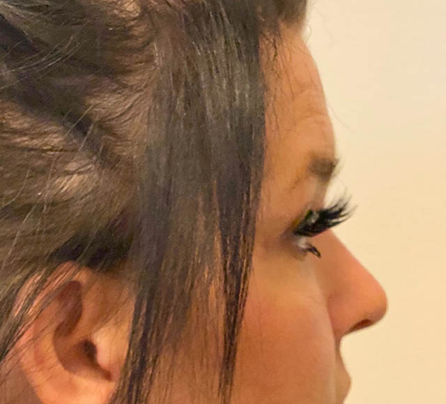 Blepharoplasty case #5316