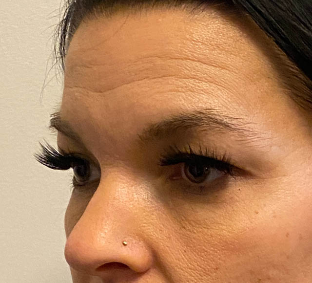 Blepharoplasty case #5316