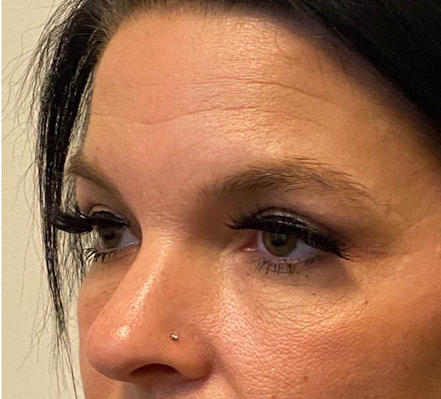 Blepharoplasty case #5316