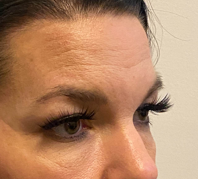 Blepharoplasty case #5316