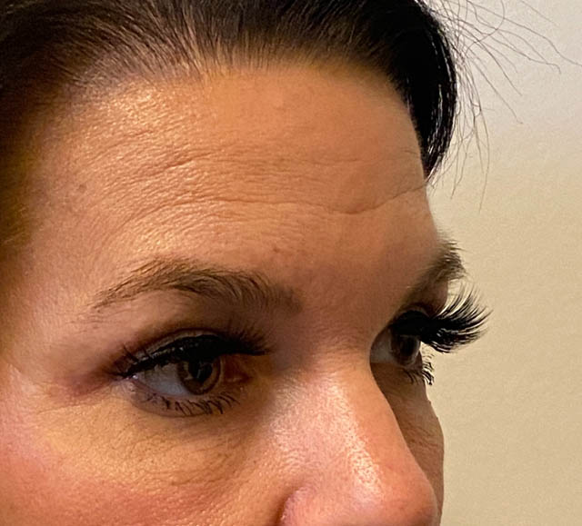 Blepharoplasty case #5316